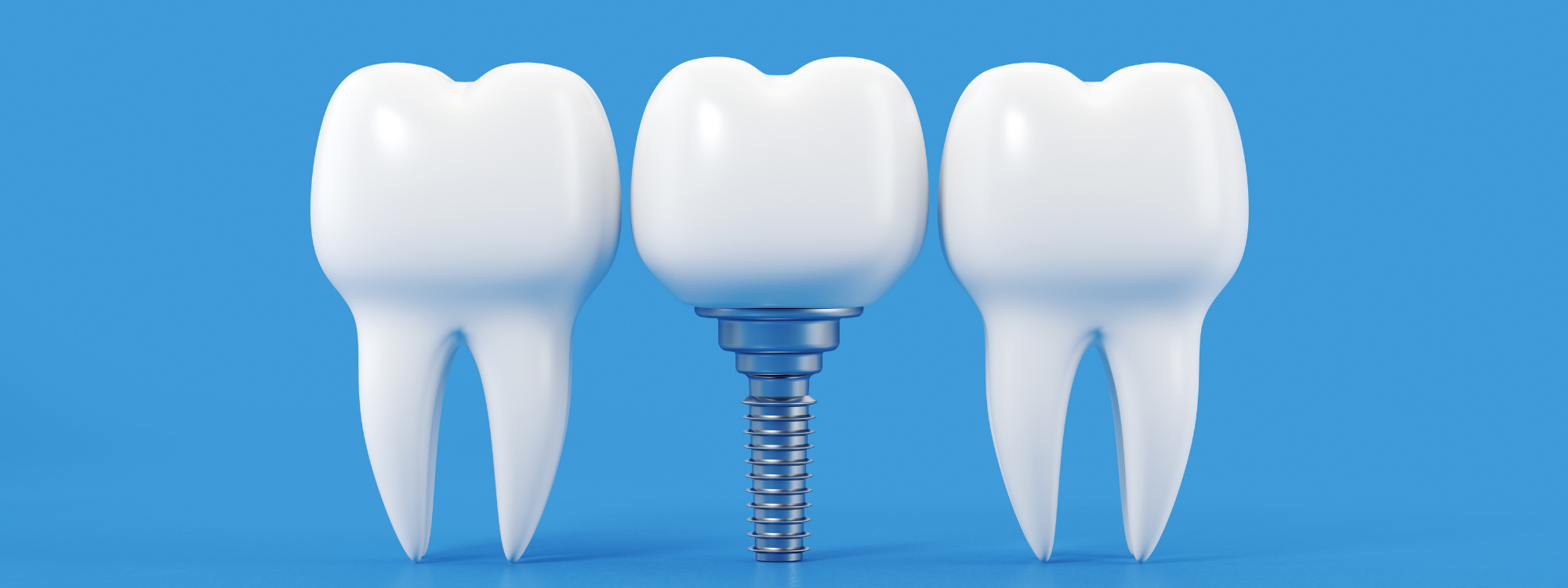 Dental Implants